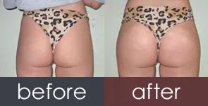 10ml Pure Hyaluronic Acid Brest Injection for Penies Enlargement Cream Buttocks and Breast Enlargement Injection