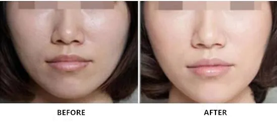 12mg 20mg 36mg 60mg 100mg Non Crosslinked Hyaluronic Acid Dermal Filler for Whole Face Injection