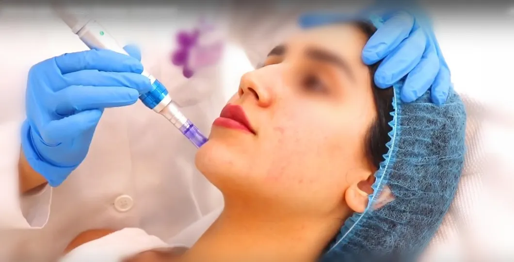 12mg 20mg 36mg 60mg 100mg Non Crosslinked Hyaluronic Acid Dermal Filler for Whole Face Injection