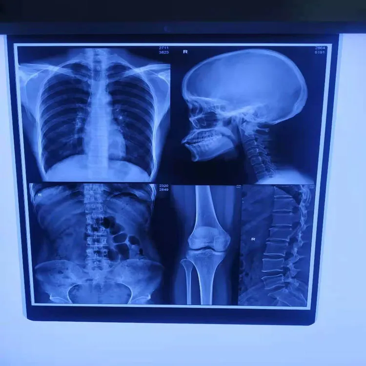 13*17in Roll Packing Blue Inkjet Medical Digital Dry Images