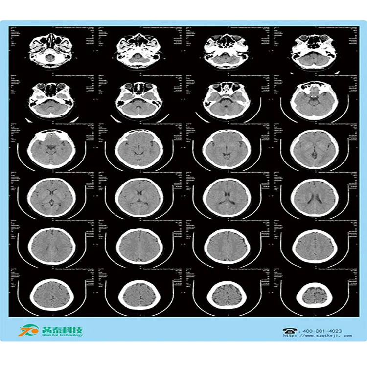 13*17in Roll Packing Blue Inkjet Medical Digital Dry Images