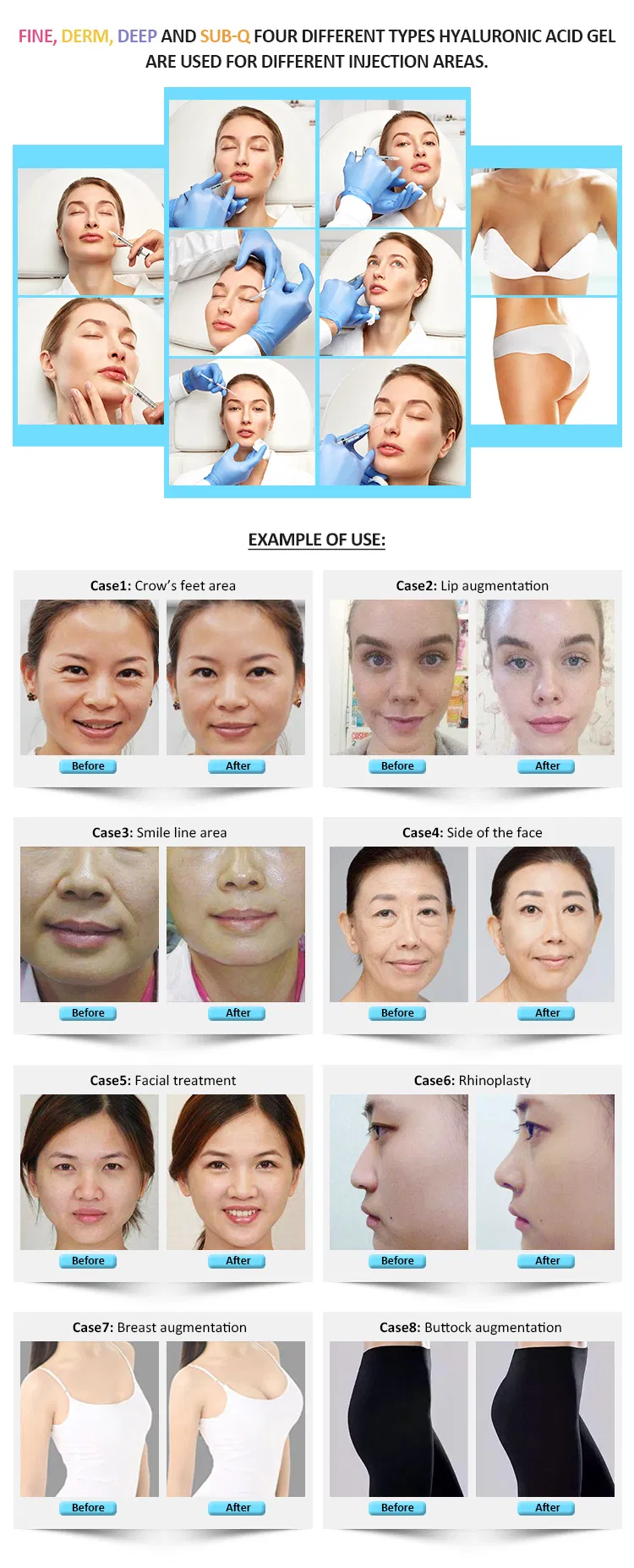 1ml Facial Chin Augmentation Cross-Linked Hyaluronic Acid Dermal Filler Injection