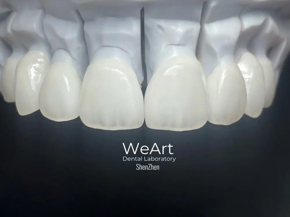 Why Is an IPS e.max Layered Porcelain Crown the Ideal Choice for Natural-Looking Restorations?