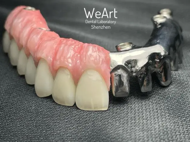 What Is a Toronto Bridge and Why Is It Essential in Modern Implant Dentistry?