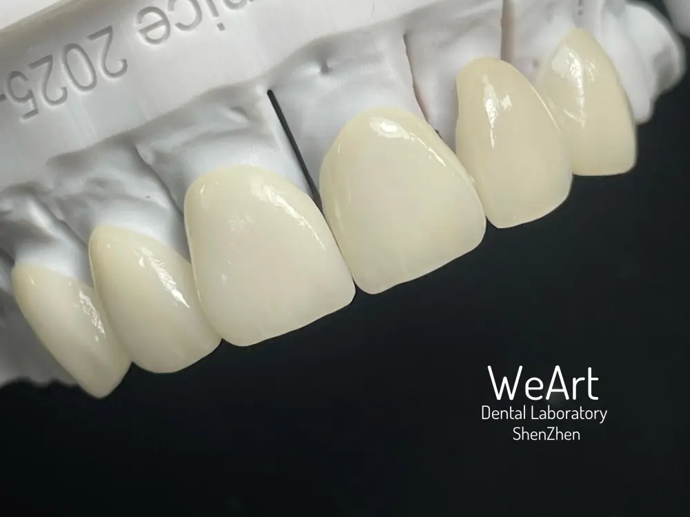 Why Is Full e.max Veneer the Gold Standard for Modern Aesthetic Dentistry?