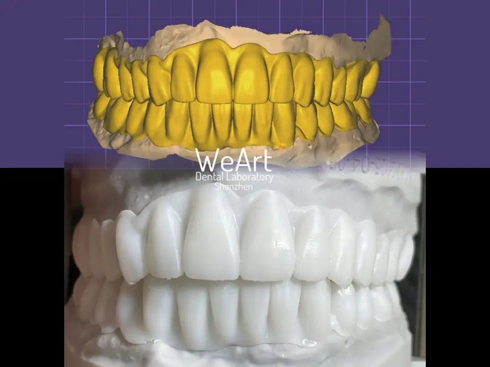 Why Is Temporary Crown Essential in Modern Restorative Dentistry?