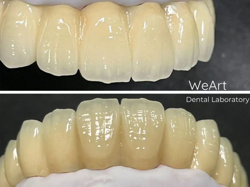 What Makes PFM Non-Precious Crown a Reliable Choice for Customized Dental Restorations?