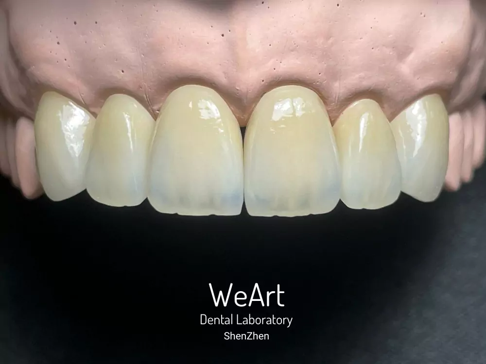 How Does a Zirconia Layered Porcelain Crown Balance Strength and Natural Esthetics?