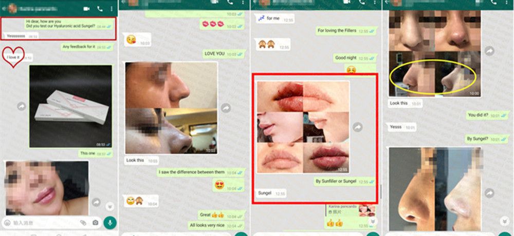 2ml Deep High Quality Hyaluronic Acid Dermal Injection Nose Chin Filler