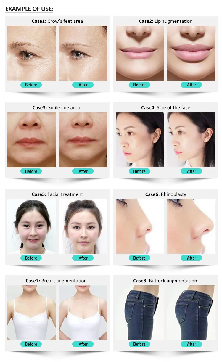 5ml Breast Butt Injection Enhancement Ha Cross Linked Hyaluronic Acid Dermal Filler Buy Direct From Factory Korea Long Lasting