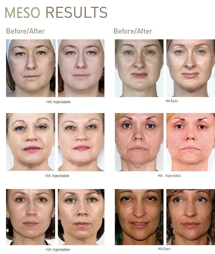 Anti-Aging Derm Pen Skin Care Retinol Meso Hyaluronic Acid 5ml