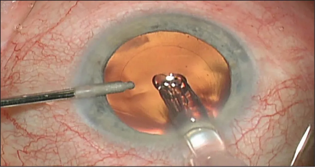 Best Viscoelastic Solution for Corneal Transplant Surgery in Endothelium Protection