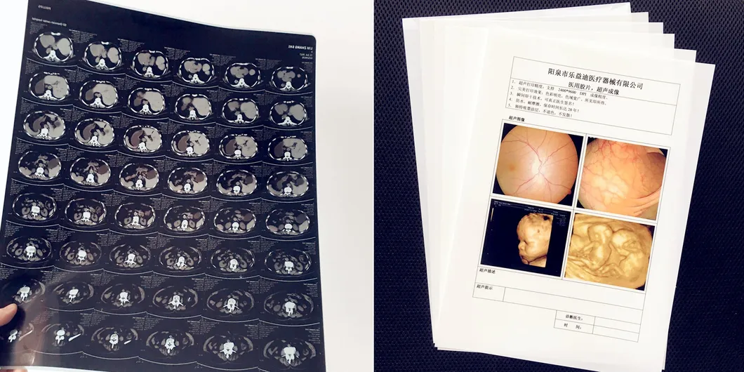 Blue/White Base Medical Dry Imaging Films 14X17 35X43 A3