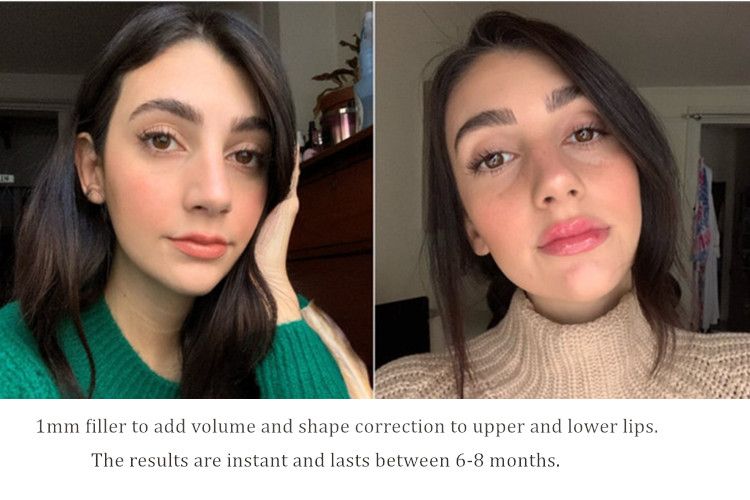 Bouliga Beed Filler Cross Linked Ha 5ml Dermal Filler for Add Volume and Enhance Lips