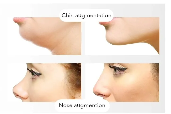 CE Approved Singfiller Dermal Filler Hyaluronic Acid Injection
