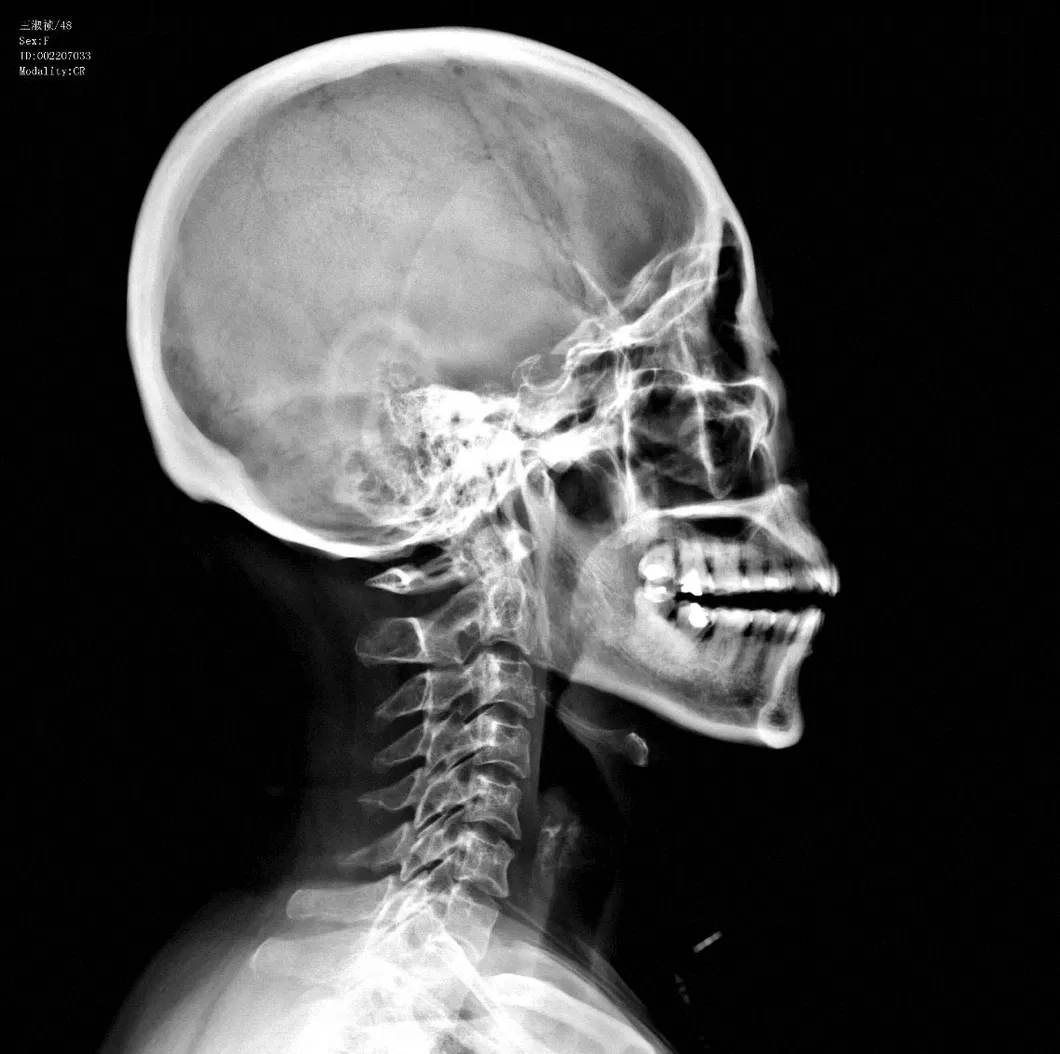 Cheap Inkjet Blue Medical X Ray Films