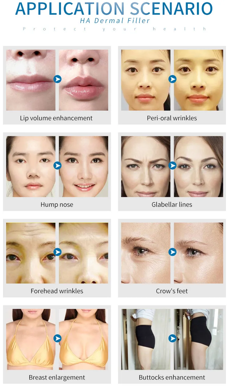China Factory Cheek Augmentation Cosmetic Dermal Filler Hyaluronic Aicd Injection