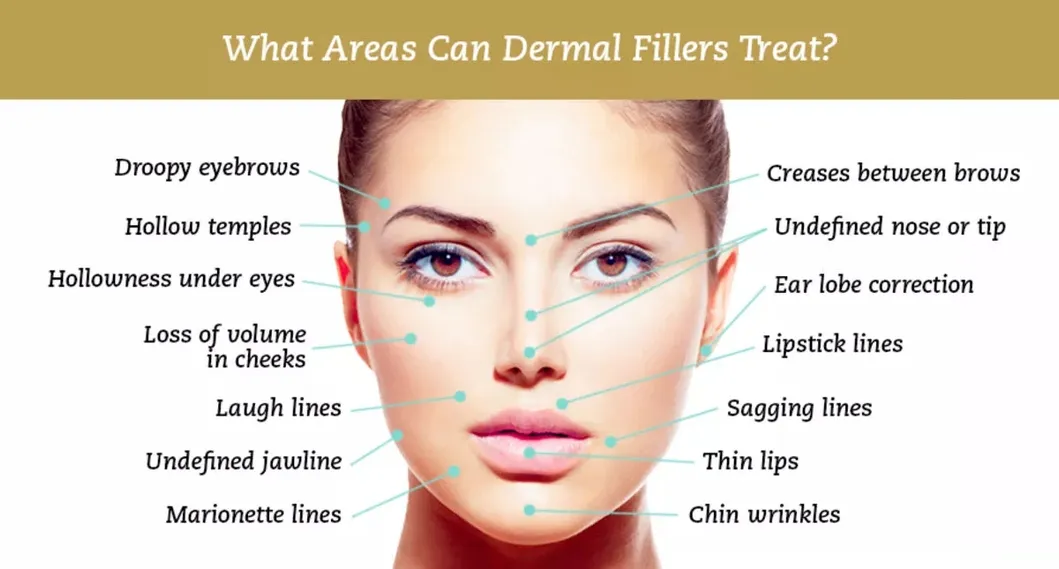 Cross-Linked Injectable Hyaluronic Acid Facial 2ml Deep Dermal Filler for Face Sharpe