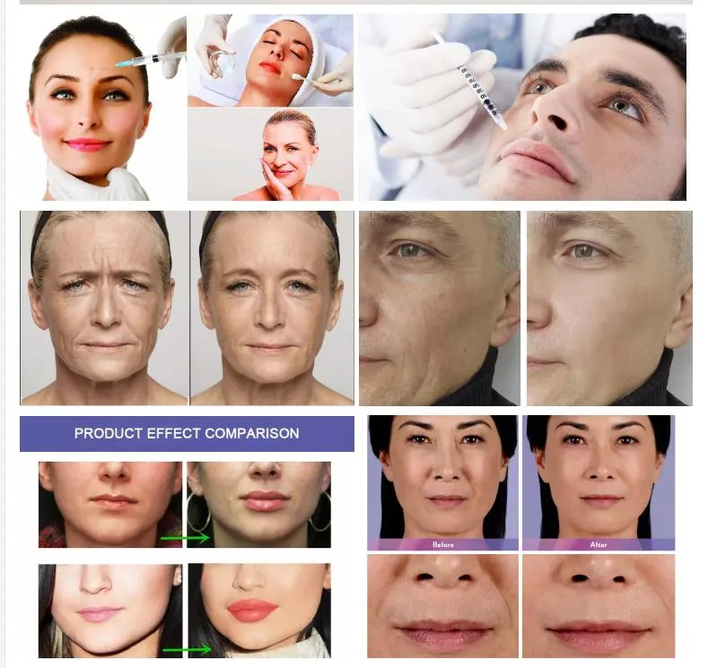 Cross-Linked Injectable Hyaluronic Acid Facial 2ml Deep Dermal Filler for Face Sharpe