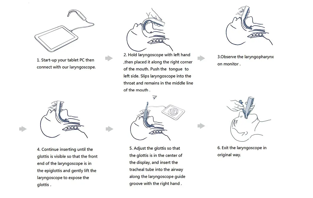 Difficult Airway Severely Ill Ventilator Airway Intubation Disposable Visual Laryngoscope