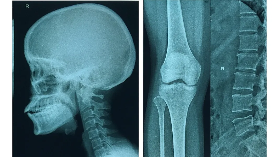 Digital Chest X-ray Films/Image for Hospital