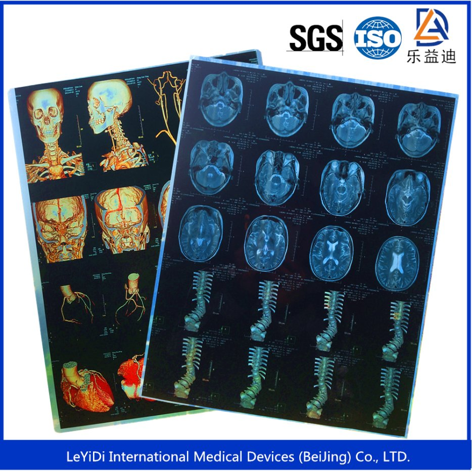 Digital Chest X-ray Films/ Image for Hospital