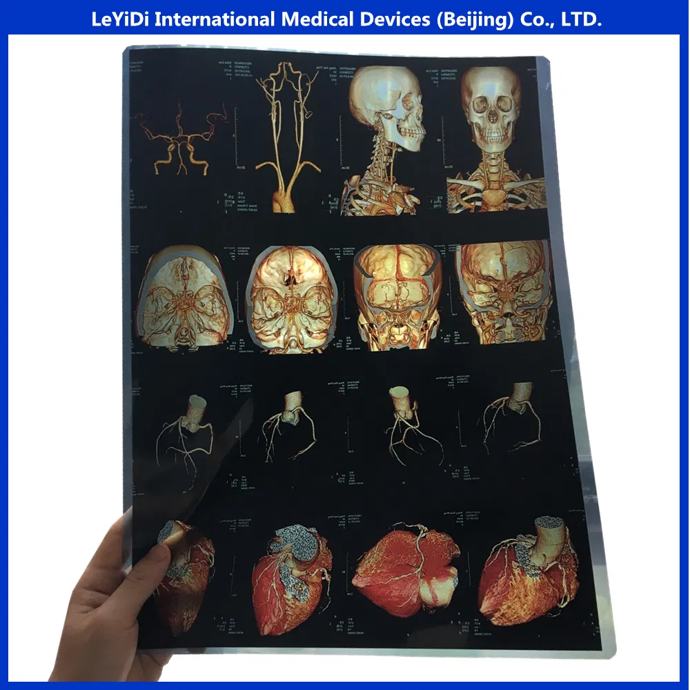 Digital Chest X-ray Films/Image for Hospital