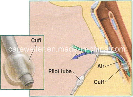 Disposable Sterile Tracheostomy Tube Cuffed