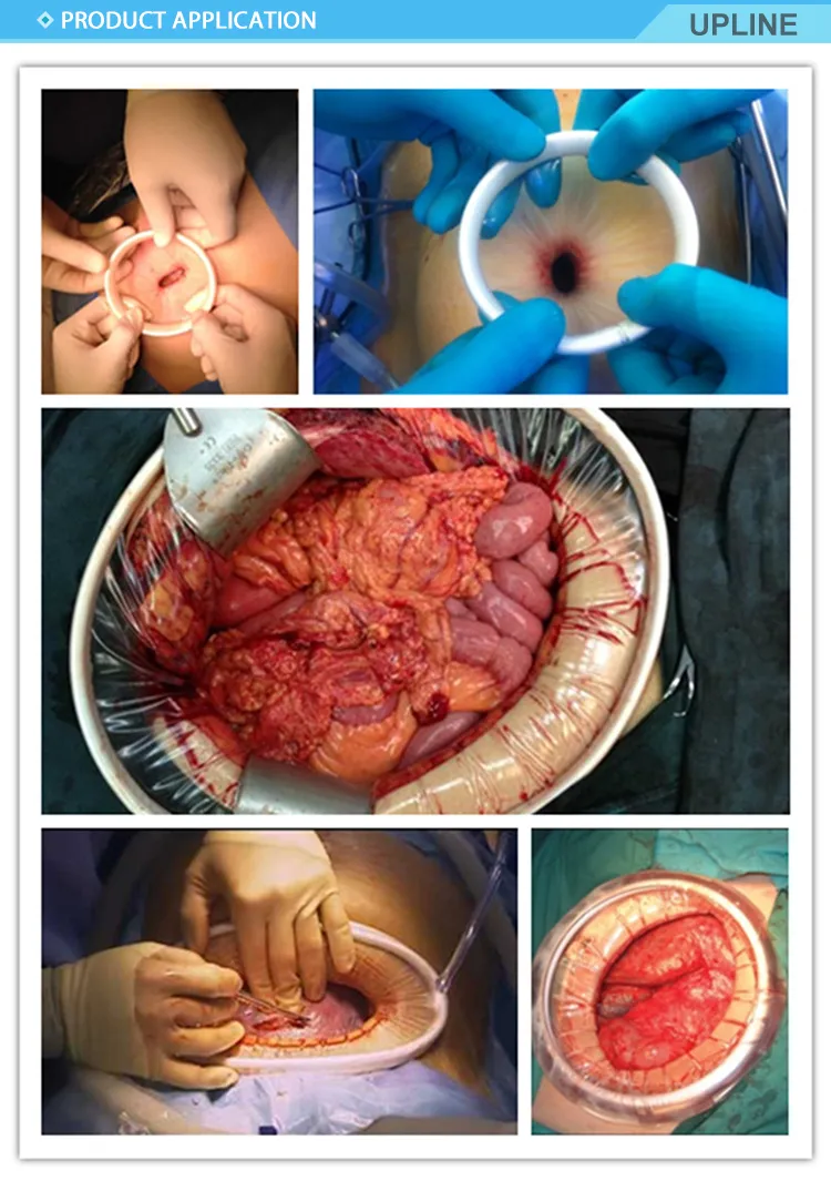 Disposable Wound Retractor for Endoscope Medical Use