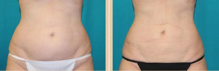 Fat Dissolving Weight Loss Korea Red Lipolytic Solution Dermal Filler