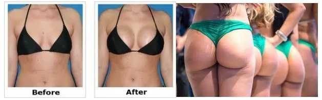 Fill with Hyaluronic Acid Brest Enlargement Injection Filler