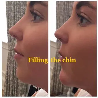 Fine/Derm/Deep 1ml 2ml Cross Linked Ha Injectable Hyaluronic Acid Dermal Filler for Nose