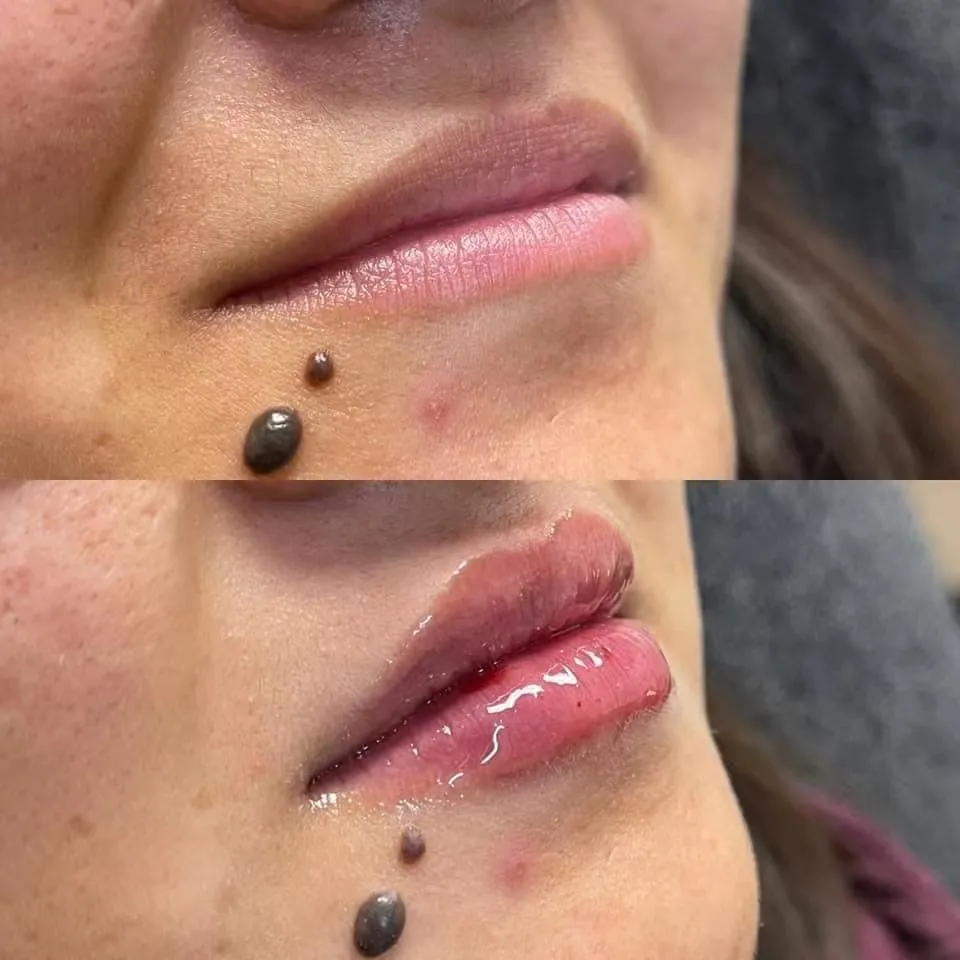 Fine/Derm/Deep 1ml 2ml Cross Linked Ha Injectable Hyaluronic Acid Dermal Filler for Nose