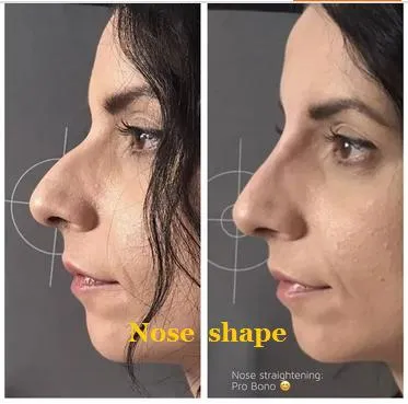 Fine/Derm/Deep 1ml 2ml Cross Linked Ha Injectable Hyaluronic Acid Dermal Filler for Nose