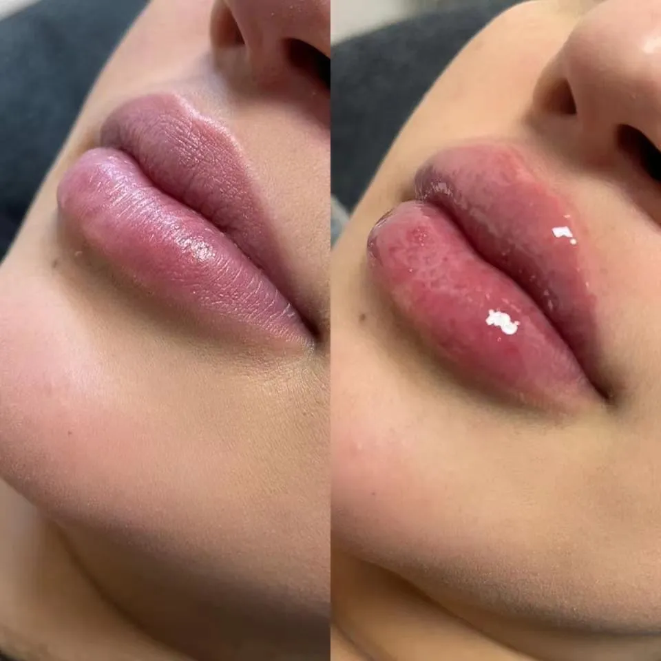 Fine/Derm/Deep 1ml 2ml Cross Linked Ha Injectable Hyaluronic Acid Dermal Filler for Nose