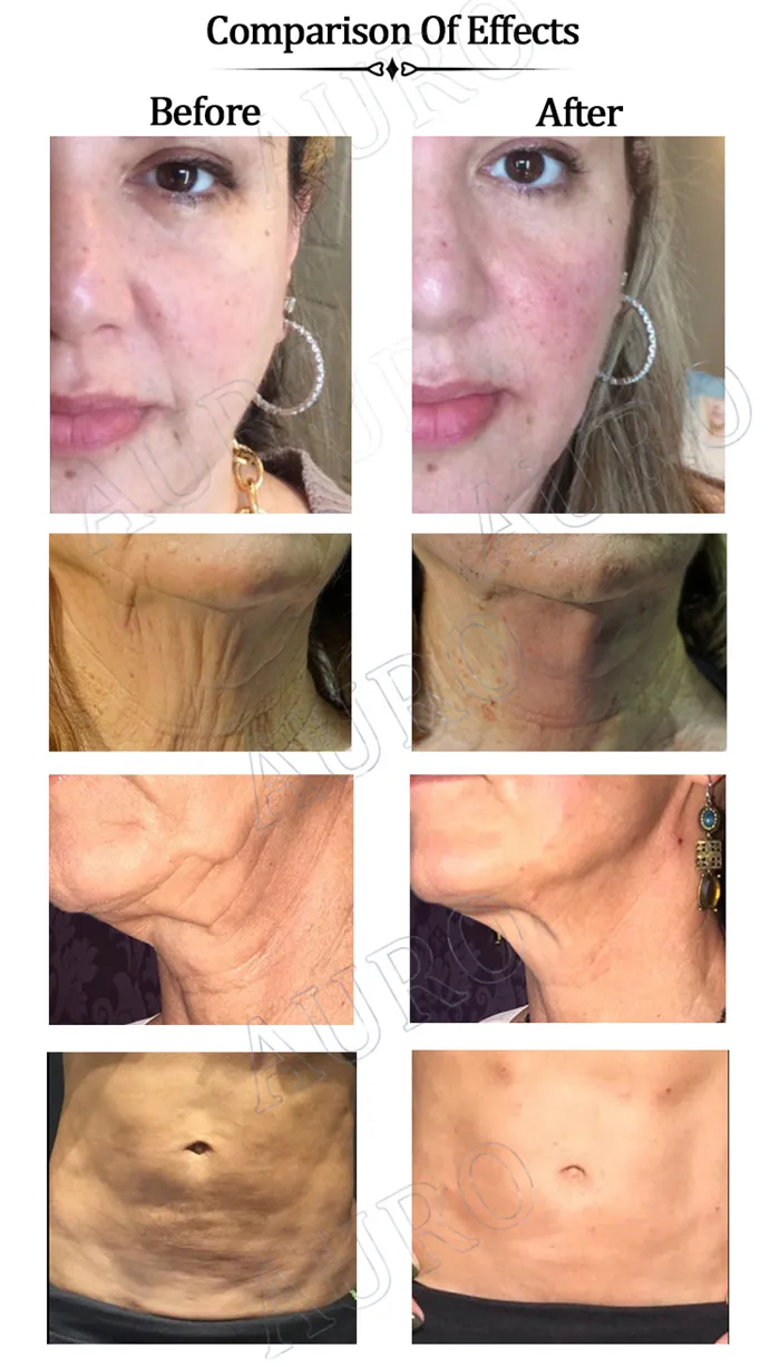 Good Quality Absorbable Facial Nose Lifting Breast Lift Strongest Tornado Cog Thread