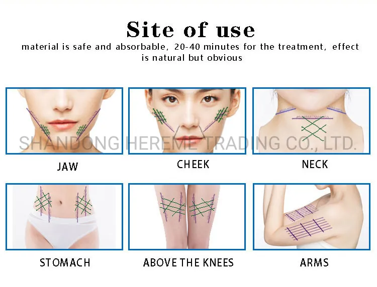Heremefill Buy Sterile Pdo Face Lifting Thread with Cogs and Barbs