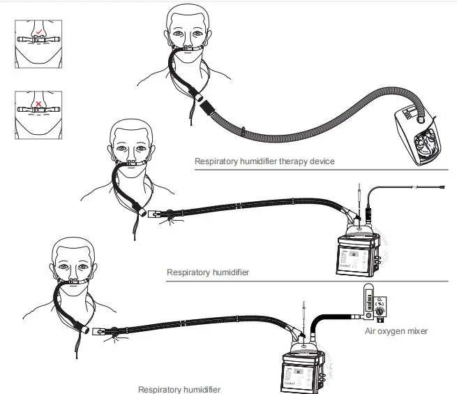 High Flow Nasal Cannula Hfnc for Airvo2