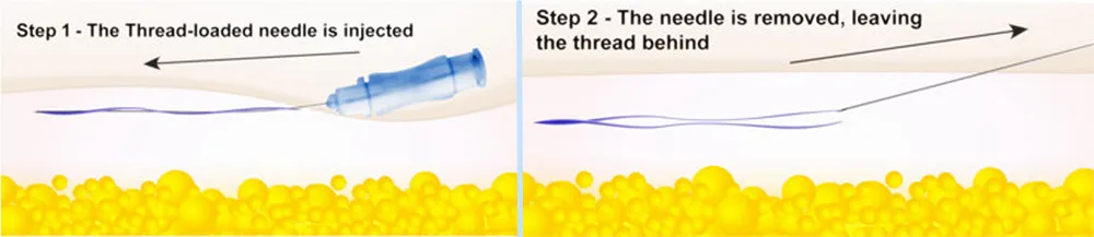 Hot Selling Safe Korea Face V Lifting Pdo Thread Mono Cog