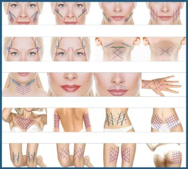 Hot Selling Safe Korea Face V Lifting Pdo Thread Mono Cog