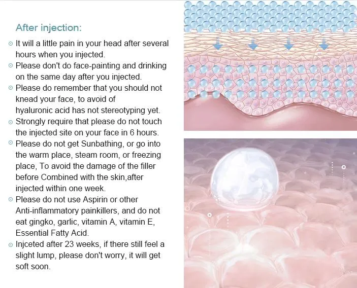 Hyaluronic Acid Dermal Fillers for Chin Area Sagging Jowls Injection Sodium Hyaluronate Gel