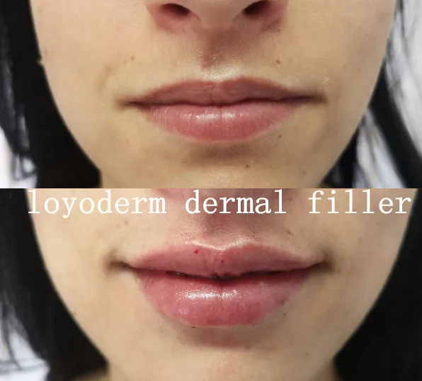 Hyaluronic Acid Ha Gel Filer Injections for Men Enlargment Penis