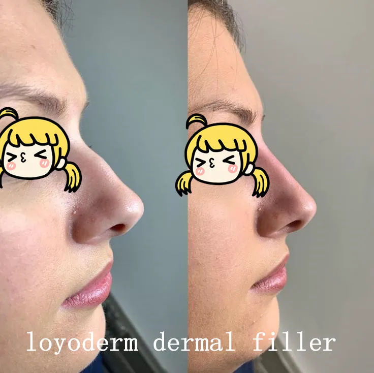 Hyaluronic Acid Ha Gel Filer Injections for Men Enlargment Penis