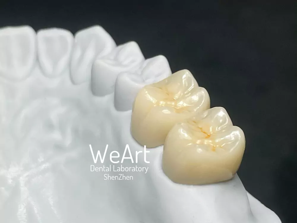 Full Zirconia Crown