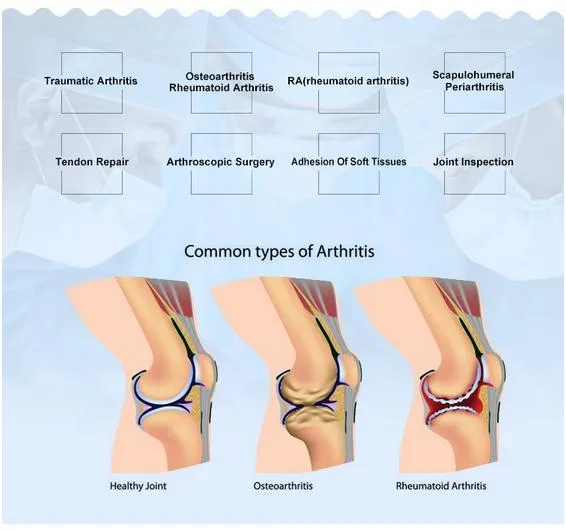 Intra-Articular Hyaluronic Acid Injection Gel in The Knee Joints for Osteoarthritis Injection