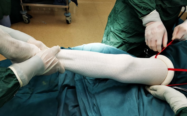 Latex-Free Silicone Elastic Ring Disposable Sterile Exsanguinating Tourniquet Cuff for Bloodless Limb Surgery Orthopedic Non-Pneumatic Equipment