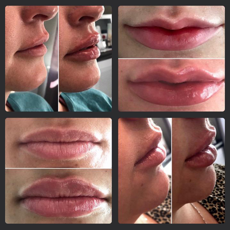Long Lastingha Dermal Filer Hyaluronic Acid Filler for Face, Lips 5ml Dermal Filler for Lip Fullness