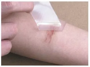 Medical Silicone-Get Sheet for Scar Hyperplasia and Skin Transplantation Surgery
