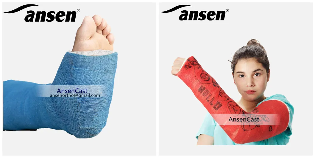 Medical Supplies Fibreglass Casting Tape FDA Approved Fabric Fiber Glass Orthopedic Casting Tape Optima Casts for Fractures