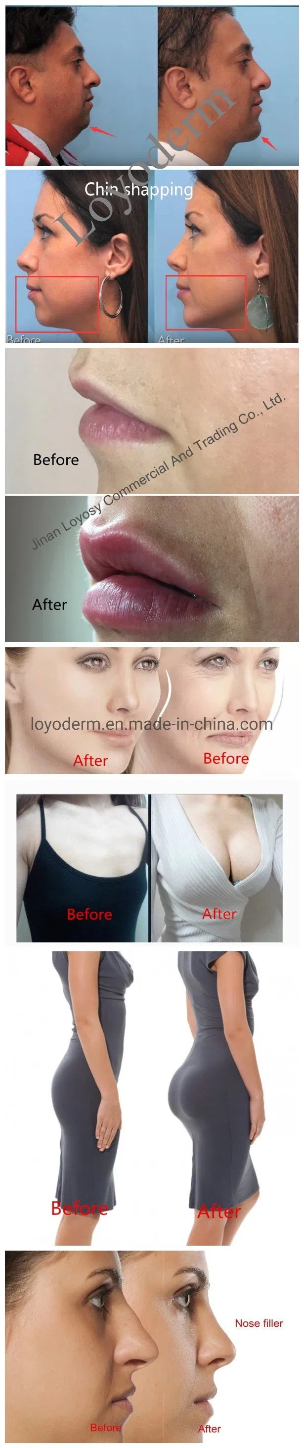 Original Manufacturer Supplied High Quality Dermal Use Cross-Linked Hyaluronic Acid Gek Filler Ha Filler